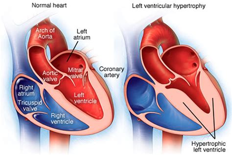 lv hypertrophy|symptoms of Lv hypertrophy.